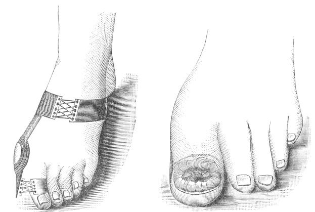 Schwarze und weiße Zeichnung eines Paares Füße, einer mit einem verbundenen Bruch und der andere mit einem freiliegenden Bruch, beschriftet für medizinische Zwecke.